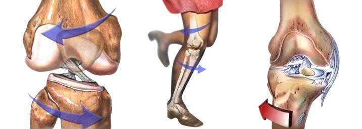 ACL Knee Injuries
