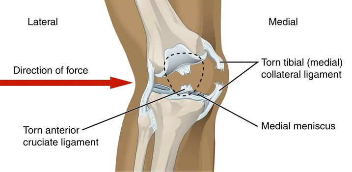 MCL Injury